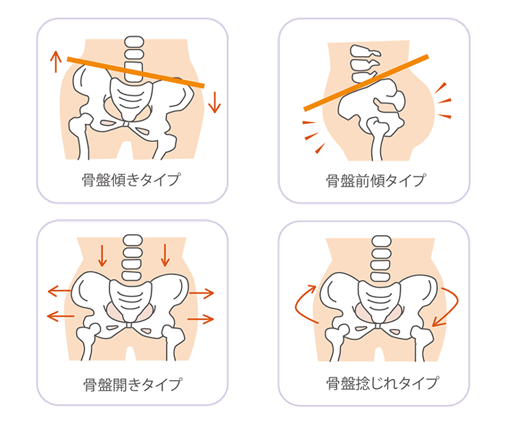 骨盤の歪みタイプ４つ