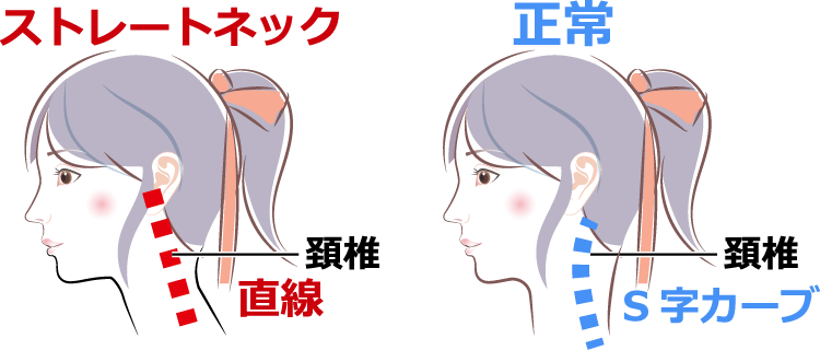 ストレートネックの説明